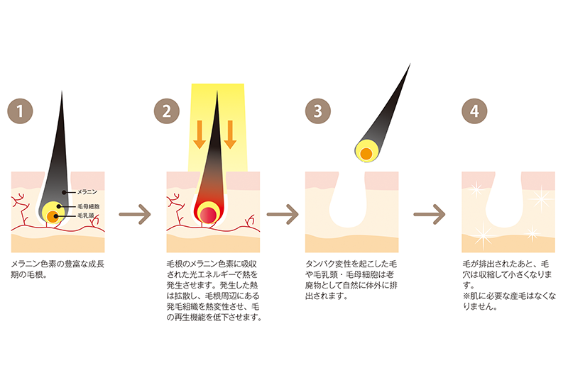 光脱毛の仕組み